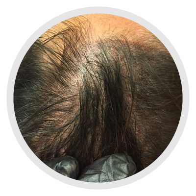 Imagen Micropigmentación Paramédica